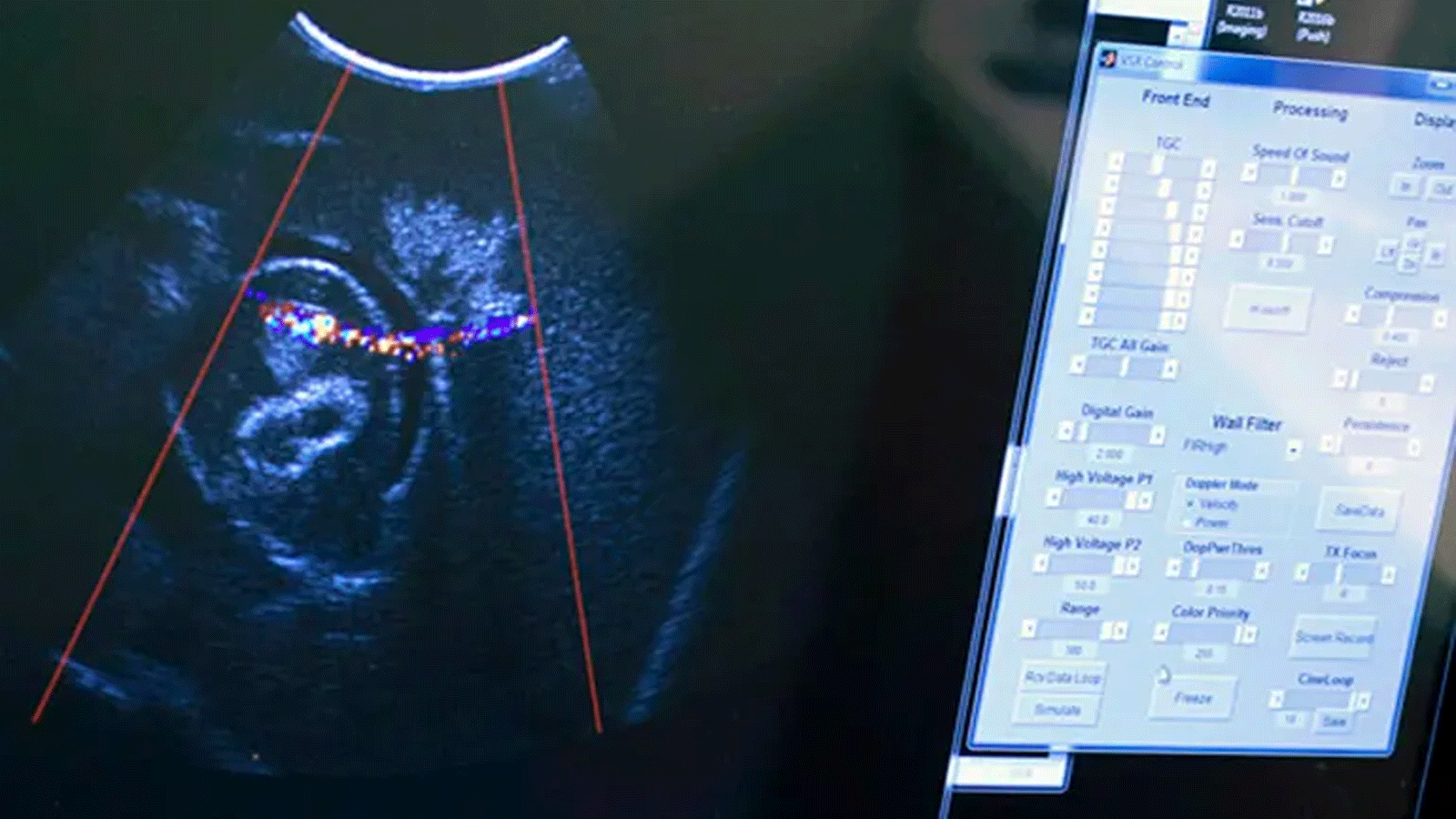 علاجٌ جديد لحصوات الكلى يستخدم الموجات فوق الصوتية لتحريك وتفتيت الحصوات الكلوية دون تخدير. (جامعة واشنطن)