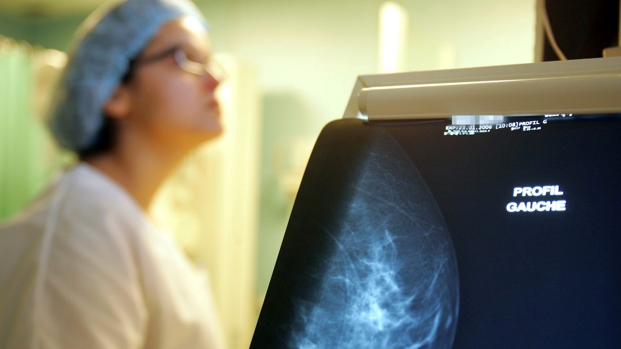 صورة التقطت بعد تصوير الثدي بالأشعة السينية في منشأة طبية في فرنسا