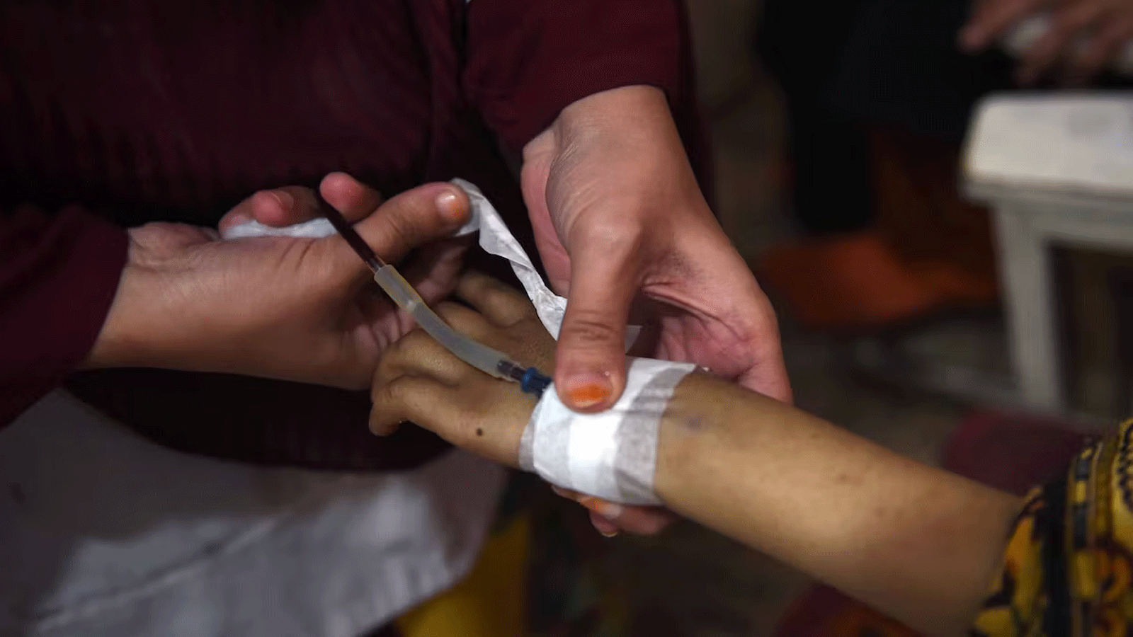 صورة لعملية نقل دم إلى طفل يعاني من فقر الدم