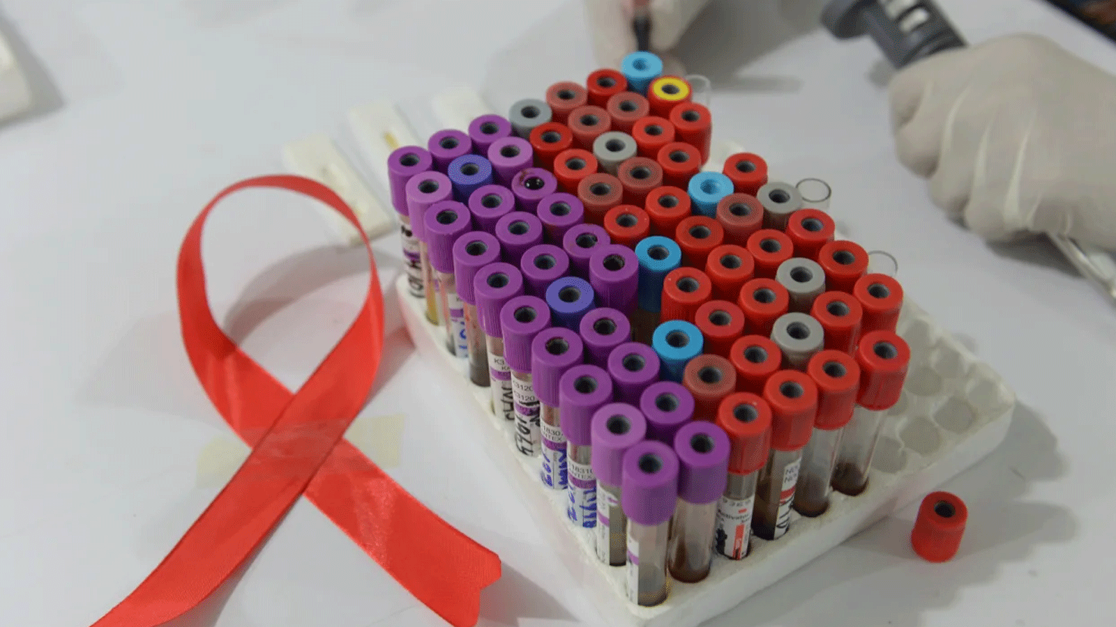الأبحاث تستمر لإيجاد علاج نهائي لفيروس نقص المناعة البشرية / الإيدز المزمن والقاتل في بعض الأحيان