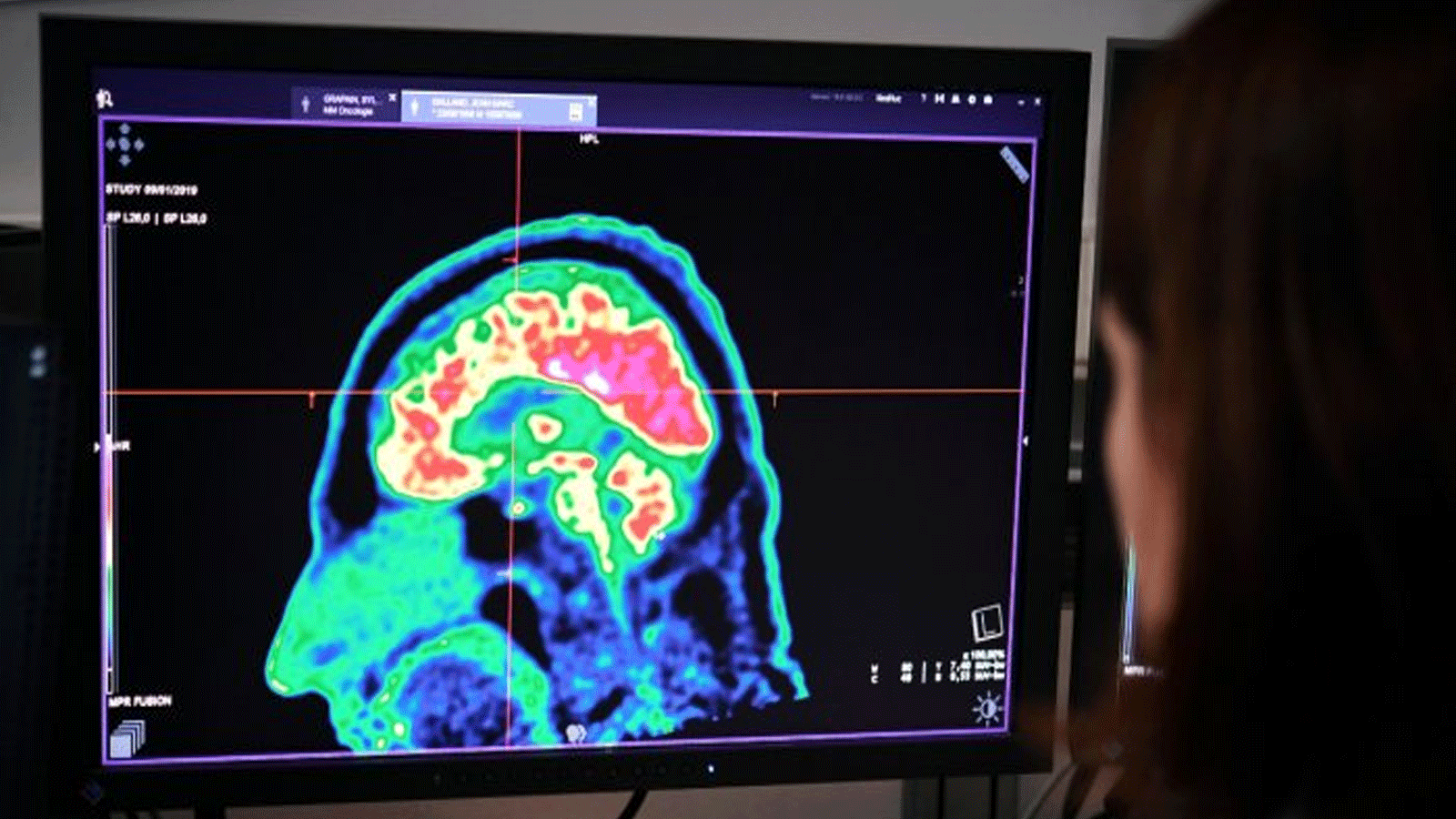 صورة توضيحية لوضع الدماغ المصاب بالالزهايمر على صورة PET scan