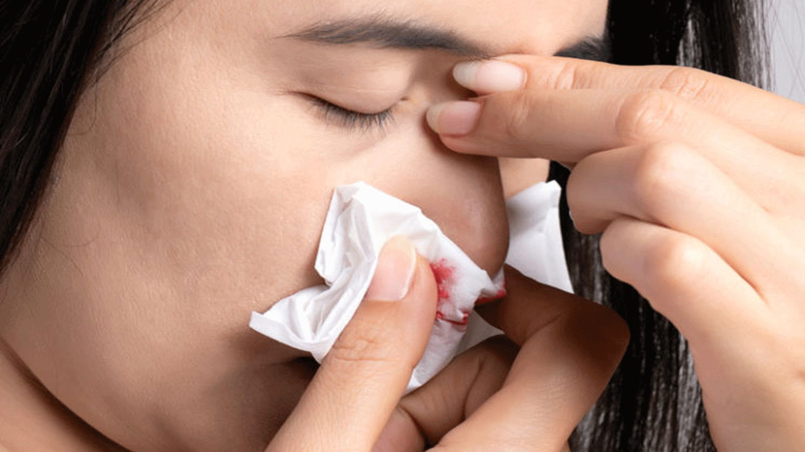 صورة توضيحية لنزيف الأنف