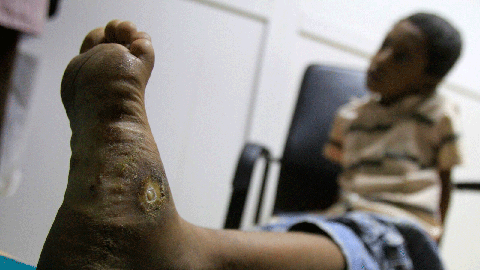 مريض في مركز أبحاث المايستوما في الخرطوم، السودان.