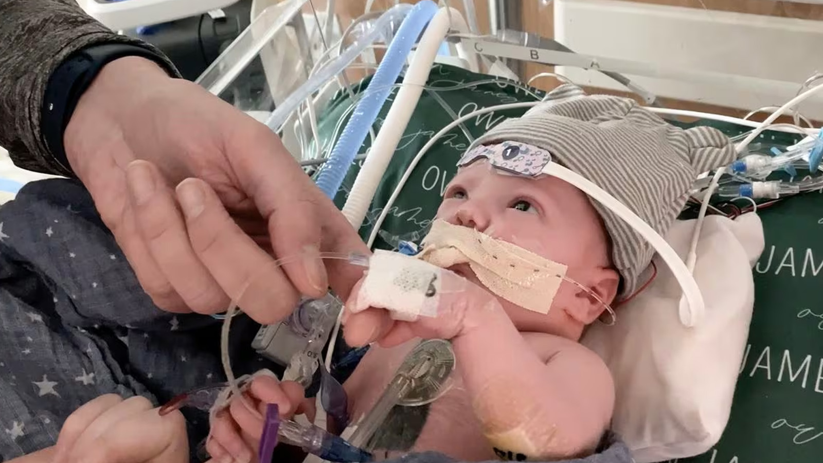 أوين مونرو، يبلغ من العمر بضعة أسابيع فقط، بعد خضوعه لعملية زرع قلب جزئي في مستشفى جامعة ديوك -نورث كارولينا- الولايات المتحدة الأميركية (DUKE HEALTH)