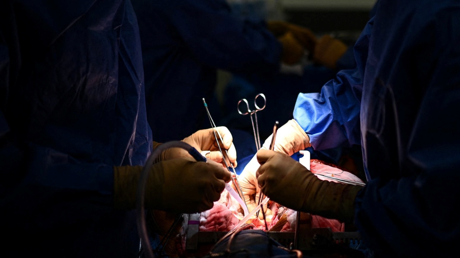 جراحون أميركيون يتمكنون للمرة الأولى من زرع كلية خنزير معدّل وراثياً لمريض حيّ