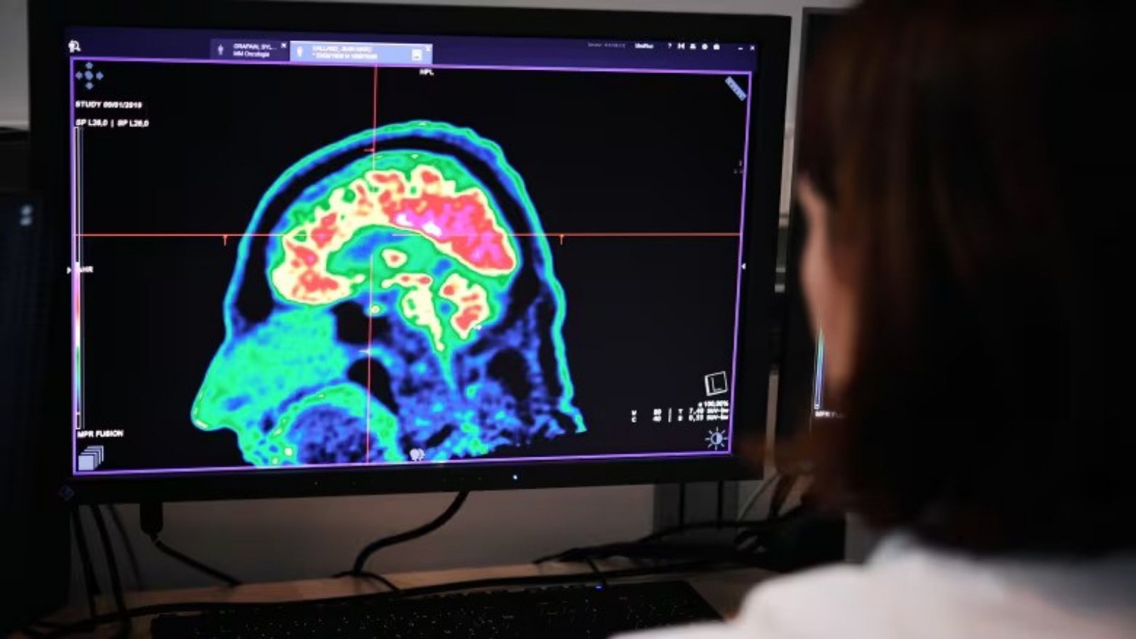 صورة لدماغ بشري تم التقاطها بواسطة فحص PET، في مركز المستشفى الإقليمي والجامعي في بريست في غرب فرنسا