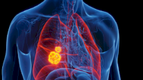 علماء يحذرون: سرطان الرئة يفتك بغير المدخنين