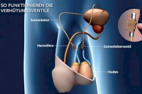 صمام الكتروني يتحكم بتدفق المني لدى الرجال