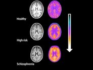 الإصابة بالشيزوفرينيا مُرتبطة بجهاز المناعة