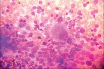 أول إصابة لإنسان بالسرطان نتيجة عدوى 