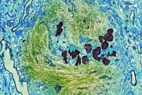 دراسة: جزئ يزيل صفائح الزهايمر من مخ الفئران