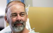 أول عملية ناجحة في العالم لزرع فروة رأس كاملة