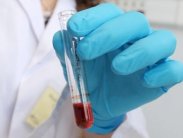 فئة الدم تحدد احتمال الإصابة بالخرف