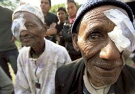 خلايا جذعية لعلاج فقدان البصر لدى المتقدمين في السن