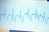 العقاقير المخفضة للكوليسترول قد تزيد خطر الإصابة بالنوبات القلبية