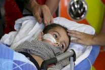 علاج السرطان بالإشعاع البروتوني 