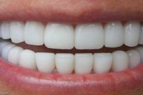 التهاب اللثة قد يؤدي الى الاصابة بأمراض القلب 