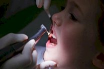 ارتفاع نسبة تسوس الأسنان لدى الأطفال في انجلترا