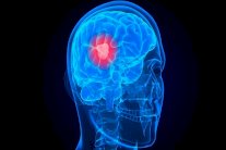 علماء ألمان يطورون لقاحاً ضد سرطان الدماغ