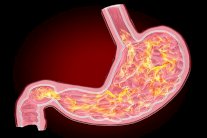 أدوية حرقة المعدة قد تزيد خطر الخرف وأمراض القلب والكلى