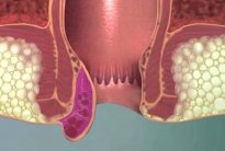 الغذاء الصحي والرياضة العلاج الصحي للبواسير
