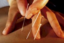 العلاج الصيني بالإبر يرمّم الذاكرة
