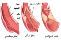 الكولسترول يهدد صحة القلب والغذاء الصحي أفضل علاج