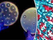 المقاومة المتعاظمة للمضادات الحيوية تنذر بنهاية الطب