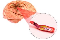أطباء في دبي يبتكرون تقنية تمنع الجلطات الدماغية