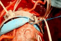 روبوت يعانق القلب لاستمرار النبض