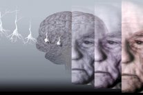 35 عقارًا واعدًا للقضاء على ألزهايمر