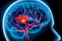 الجلطة تضاعف خطر الإصابة بالخرف