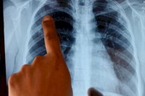 عقار جديد يخفض وفيات سرطان الرئة الى الثلث