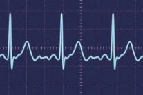اضطراب ضربات القلب يهدد بالعته في مرحلة لاحقة من العمر