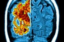 هكذا يمكن أن ينتقل الزهايمر كعدوى إلى الإنسان!