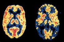 للمرة الأولى... تحييد جين الزهايمر في الدماغ
