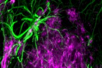 استخدام الخلايا النجمية لوقف تقدم الزهايمر
