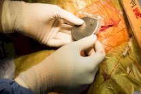 تقنية متطورة تحد من الالتهابات الحادة لدى زراعة أجهزة قلبية