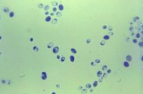 فطريات كانديدا البيكانس قد تسبب الزهايمر