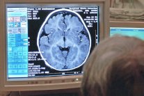 دواء لعلاج الجلطة يوفر وقاية ضد مرض الزهايمر