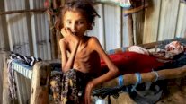اليمن: 400 ألف طفل يواجهون خطر الموت هذا العام جرّاء شح الغذاء