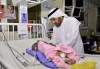 وزير الصحة السعودي: التوأم السيامي العراقي بصحة جيدة