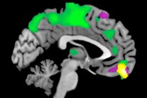 علماء يجدون المنطقة الدماغية المسؤولة عن الثقة