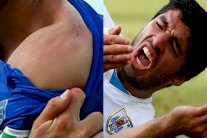 عضة الإنسان أخطر من عضة الحيوان أحيانًا!