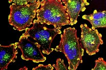 كشف سر قدرة الأورام السرطانية على الانتشار