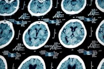 عقار يوقف تردي النشاط الذهني لمرضى الزهايمر