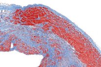 اكتشاف طريقة لترميم التلف في نسيج القلب