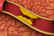 لقاح واعد ضد الجلطات القلبية