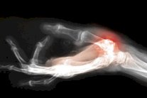 التهاب المفاصل ثمن بقاء أسلافنا في العصر الجليدي