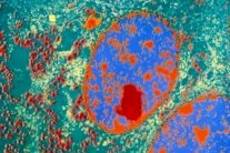 يبقى السرطان مجهولًا على الرغم من تفشّيه